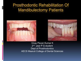 Prosthodontic Rehabilitation Of
Mandibulectomy Patients
Vinay Pavan Kumar K
2nd year P G student
Dept of Prosthodontics
AECS Maaruti College of Dental Sciences
 