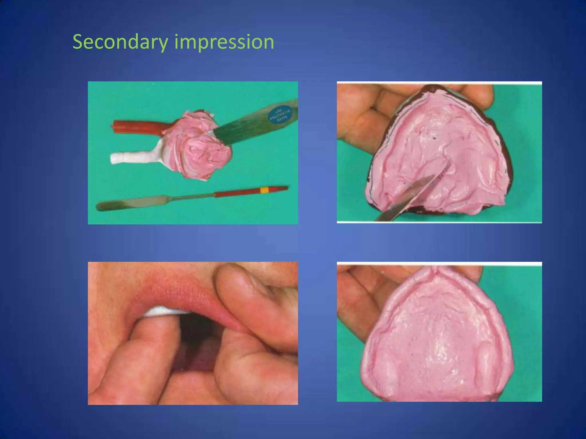 impression techniques of complete denture