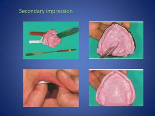impression techniques of complete denture | PPTX