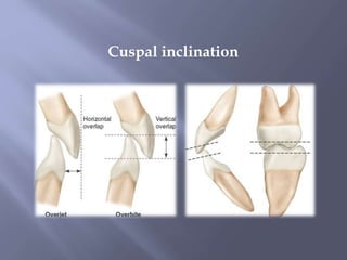 Cuspal Protection Prosthodontics | PPTX