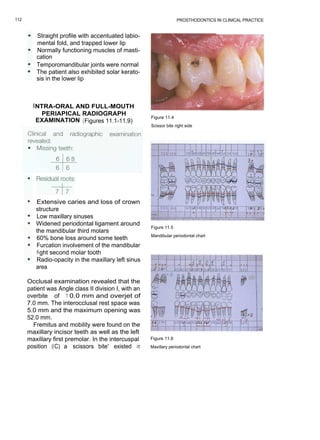 112                                                                  PROSTHODONTICS IN CLINICAL PRACTICE


         Straight profile with accentuated labio-
         mental fold, and trapped lower lip
         Normally functioning muscles of masti-
         cation
         Temporomandibular joints were normal
         The patient also exhibited solar kerato-
         sis in the lower lip



        I NTRA-ORAL AND FULL-MOUTH
           PERIAPICAL RADIOGRAPH
                                                       Figure 11.4
          EXAMINATION (Figures 11.1-11.9)
                                                       Scissor bite right side




         Extensive caries and loss of crown
         structure
         Low maxillary sinuses
         Widened periodontal ligament around
                                                       Figure 11.5
         the mandibular third molars
                                                       Mandibular periodontal chart
         60% bone loss around some teeth
         Furcation involvement of the mandibular
         ri ght second molar tooth
         Radio-opacity in the maxillary left sinus
         area

      Occlusal examination revealed that the
      patient was Angle class II division I, with an
      overbite of 1 0.0 mm and overjet of
      7.0 mm. The interocclusal rest space was
      5.0 mm and the maximum opening was
      52.0 mm.
        Fremitus and mobility were found on the
      maxillary incisor teeth as well as the left
      maxillary first premolar. In the intercuspal     Figure 11.6
      position (IC) a `scissors bite' existed in       Maxillary periodontal chart
 