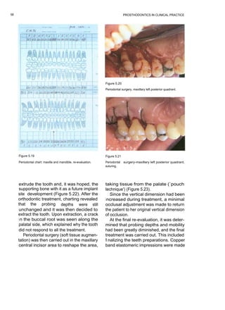58                                                                           PROSTHODONTICS IN CLINICAL PRACTICE




                                                               Figure 5.20
                                                               Periodontal surgery, maxillary left posterior quadrant.




     Figure 5.19                                               Figure 5.21
     Periodontal chart: maxilla and mandible, re-evaluation.   Periodontal   surgery-maxillary left posterior quadrant,
                                                               suturing.




     extrude the tooth and, it was hoped, the                  taking tissue from the palate (`pouch
     supporting bone with it as a future implant               technique') (Figure 5.23).
     site development (Figure 5.22). After the                     Since the vertical dimension had been
     orthodontic treatment, charting revealed                  increased during treatment, a minimal
     that the probing depths were still                        occlusal adjustment was made to return
     unchanged and it was then decided to                      the patient to her original vertical dimension
     extract the tooth. Upon extraction, a crack               of occlusion.
     in the buccal root was seen along the                         At the final re-evaluation, it was deter-
     palatal side, which explained why the tooth               mined that probing depths and mobility
     did not respond to all the treatment.                     had been greatly diminished, and the final
        Periodontal surgery (soft tissue augmen-               treatment was carried out. This included
     tation) was then carried out in the maxillary             fi nalizing the teeth preparations. Copper
     central incisor area to reshape the area,                 band elastomeric impressions were made
 