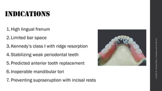Mandibular Major Connectors - Prosthodontics Seminar.pptx