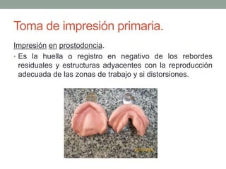 Toma de impresión primaria.
Impresión en prostodoncia.
• Es la huella o registro en negativo de los rebordes
residuales y estructuras adyacentes con la reproducción
adecuada de las zonas de trabajo y si distorsiones.
 