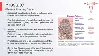 Prostate Pattern 5 Prostrate pre managment ppt | PPTX