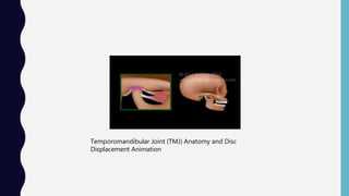 Temporomandibular Joint (TMJ) Anatomy and Disc
Displacement Animation
 