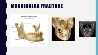 MANDIBULAR FRACTURE
 