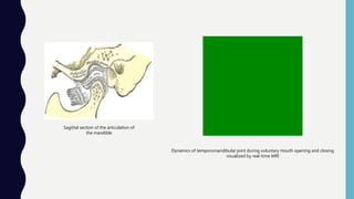 Sagittal section of the articulation of
the mandible
Dynamics of temporomandibular joint during voluntary mouth opening and closing
visualized by real-time MRI
 