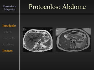 Protocolos: Abdome Introdução Bobina Protocolo Artefatos Imagem Ressonância Magnética 
