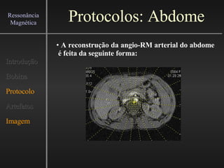 Protocolos: Abdome Introdução Bobina Protocolo Artefatos Imagem Ressonância Magnética A reconstrução da angio-RM arterial do abdome  é feita da seguinte forma:   