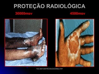 PROTEÇÃO RADIOLÓGICA
30000msv

4500msv

TCC 2007-CENTRO EDUCACIONAL ETIP

 