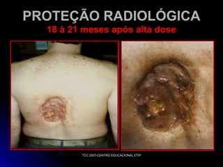 PROTEÇÃO RADIOLÓGICA
18 à 21 meses após alta dose

TCC 2007-CENTRO EDUCACIONAL ETIP

 