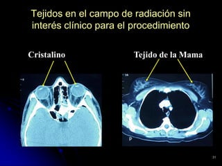 Tejidos en el campo de radiación sin
interés clínico para el procedimiento
Cristalino

Tejido de la Mama

31

 