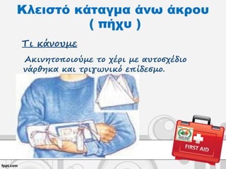 Τι κάνουμε
Ακινητοποιούμε το χέρι με αυτοσχέδιο
νάρθηκα και τριγωνικό επίδεσμο.
Κλειστό κάταγμα άνω άκρου
( πήχυ )
 