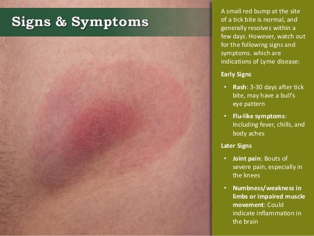 How To Treat A Tick Bite Naturally How To Treat A Tick Bite Naturally