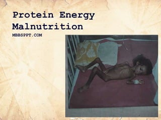 Protein Energy
Malnutrition
MBBSPPT.COM
 