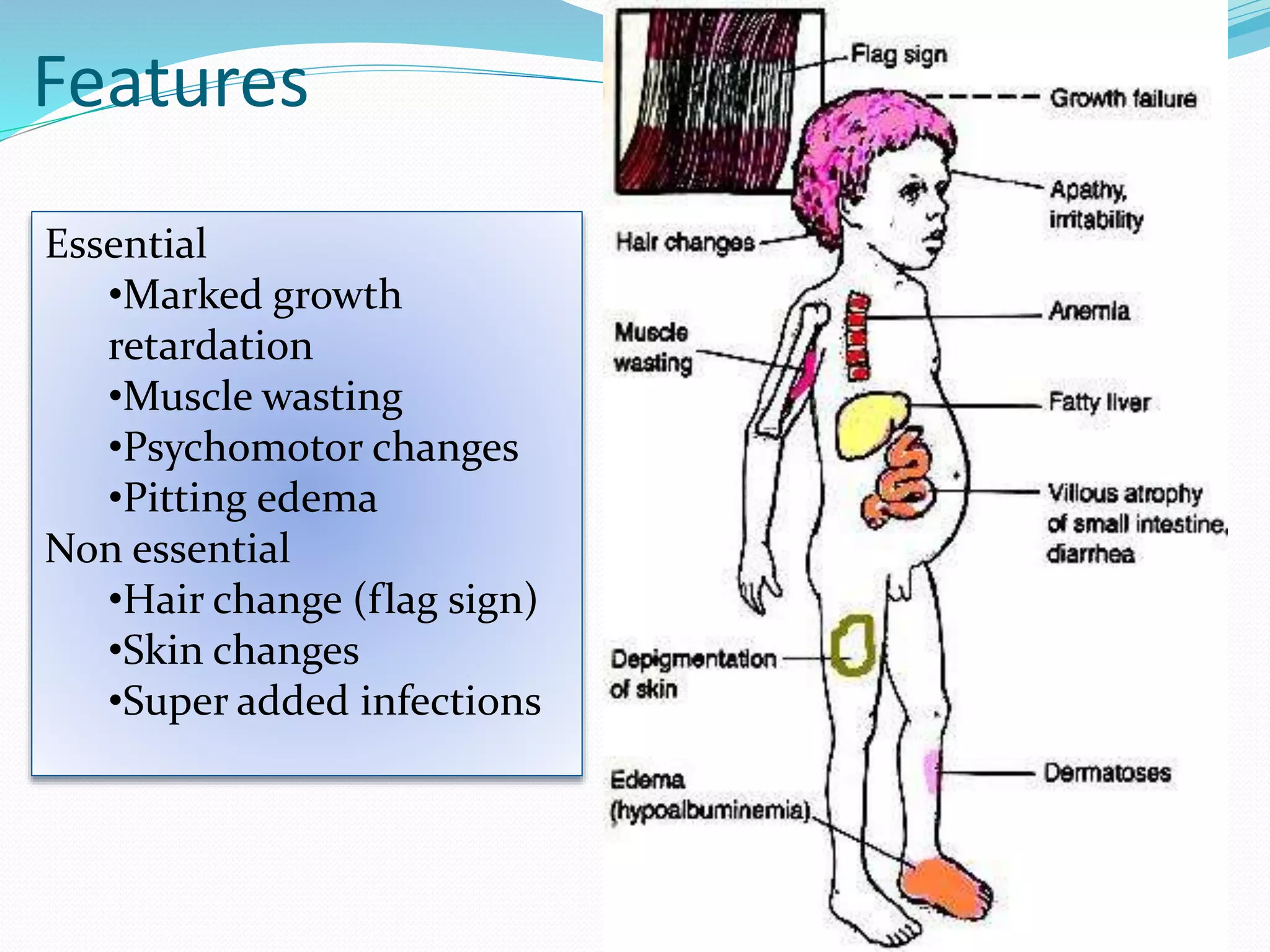 Protein energy malnutrition | PPTX