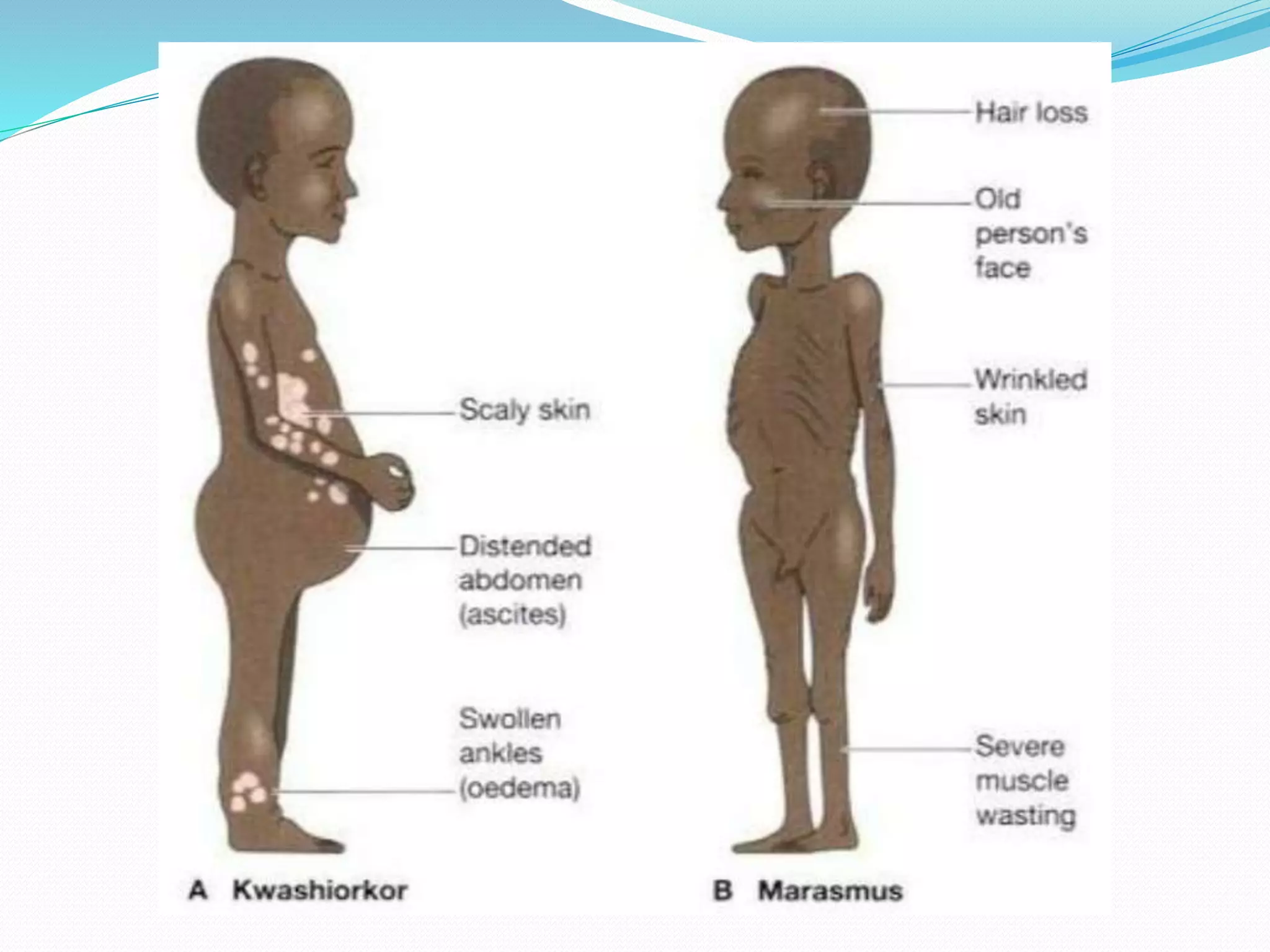 Protein Energy Malnutrition PPTX protein-energy-malnutrition-pptx