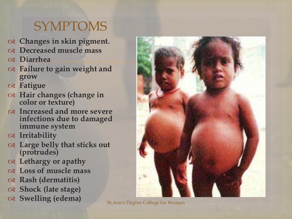 Protein Energy Malnutrition