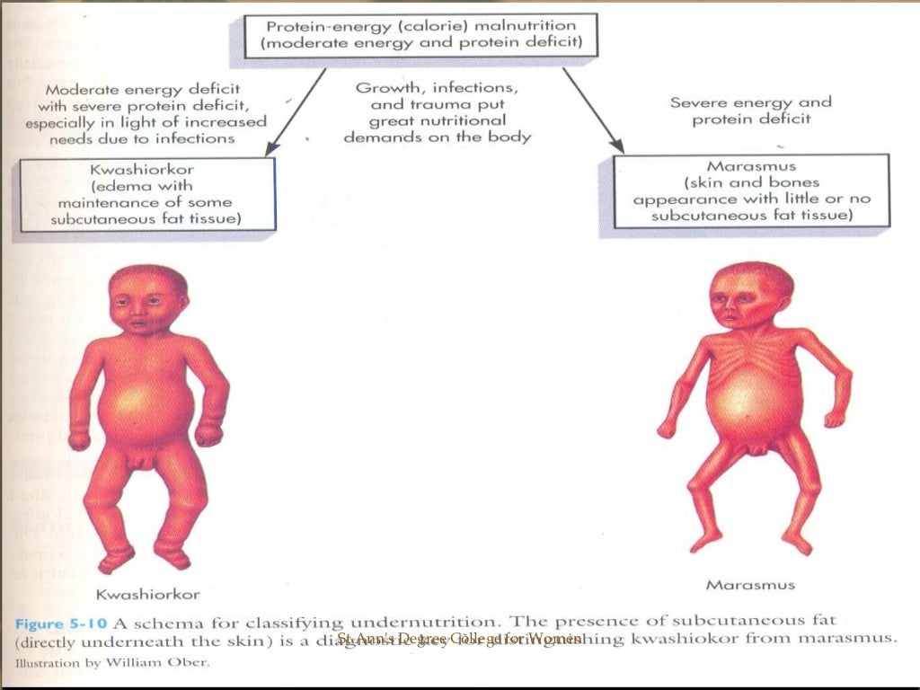 Protein Energy Malnutrition