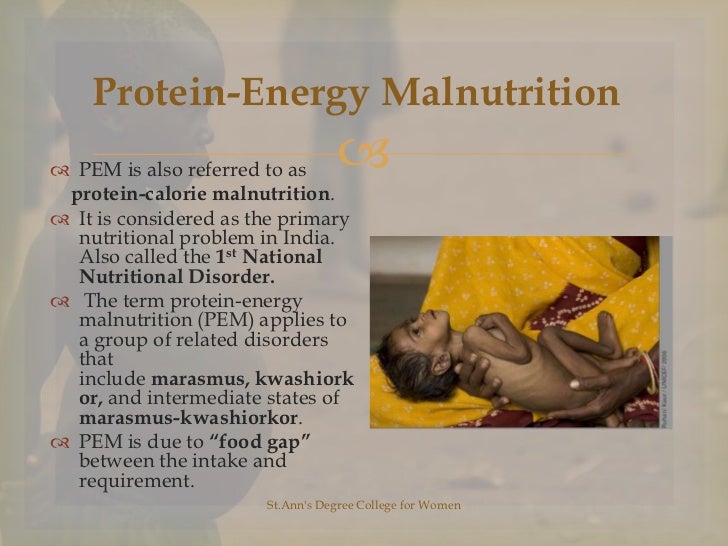 research on protein energy malnutrition