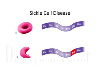Sickle Cell Disease
 