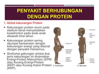 PENYAKIT BERHUBUNGAN
DENGAN PROTEIN
1. Akibat kekurangan Protein
 Kekurangan protein murni pada
stadium berat menyebabkan
kwashiorkor pada anak-anak
dibawah lima tahun.
 Kekurangan protein sering
dijumpai bersamaan dengan
kekurangan energi yang dikenal
dengan penyakit marasmus.
 Sindroma gabungan antara dua
jenis kekurangan ini dinamakan
Energi-Protein Malnutrition (EPM)
atau Kurang Energi-Protein
(KEP) atau Kurang Kalori-Protein
(KKP).
 
