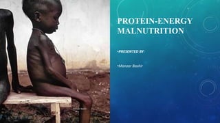 PROTEIN-ENERGY
MALNUTRITION
•PRESENTED BY:
•Manzar Bashir
Manzar Bashir
 