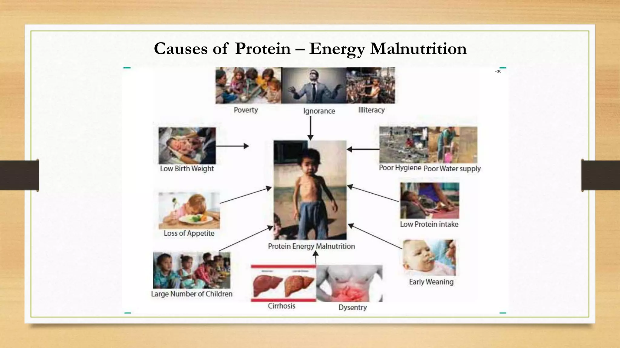 Protein energy malnutrition | PPT