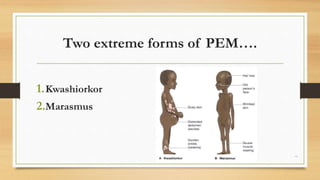 Protein energy malnutrition | PPTX