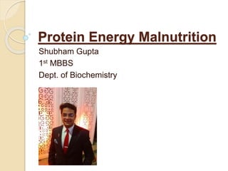 Protein Energy Malnutrition
Shubham Gupta
1st MBBS
Dept. of Biochemistry
 