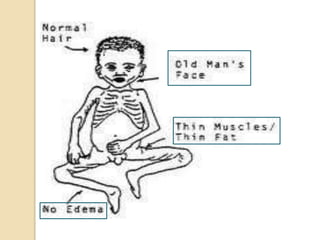 Protein Energy Malnutrition | PPTX