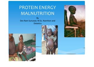 PROTEIN ENERGY
MALNUTRITION
By
Dev Ram Sunuwar, M.Sc. Nutrition and
Dietetics
 