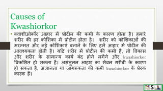 Protein energy malnutrition in children hindi | PPTX