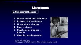 Kwashiorkor  Marasmus II Clinical features and differences  YouTube