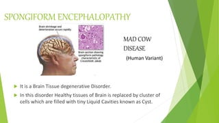 SPONGIFORM ENCEPHALOPATHY
 It is a Brain Tissue degenerative Disorder.
 In this disorder Healthy tissues of Brain is replaced by cluster of
cells which are filled with tiny Liquid Cavities known as Cyst.
MAD COW
DISEASE
(Human Variant)
 