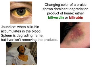 Jaundice: when bilirubin
accumulates in the blood.
Spleen is degrading heme,
but liver isn’t removing the products.
Changing color of a bruise
shows dominant degradation
product of heme: either
biliverdin or bilirubin
 