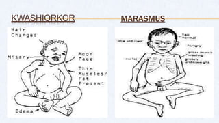 KWASHIORKOR MARASMUS
 