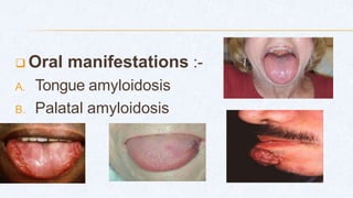  Oral manifestations :-
A. Tongue amyloidosis
B. Palatal amyloidosis
 
