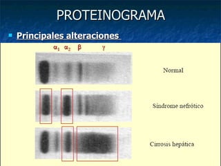 PROTEINOGRAMA Principales alteraciones  