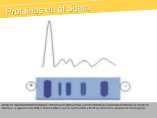 Proteínas en el SueroBandas del espectroelectroforético (abajo) y representación gráfica (arriba). La primera banda por la izquierda corresponde a la fracción de albúminas. La segunda a la de Alfa1, la tercera a Alfa2, la cuarta y quinta a Beta1 y Beta2 y la última por la izquierda a la fracción gamma.