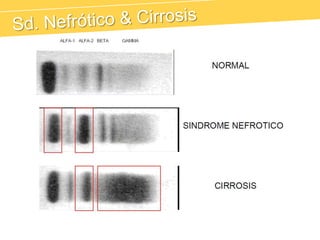 Proteína Fijadora de TiroxinaCHCReacción de Fase AgudaInfección, Inflamación, Fiebre, NeoplasiasEmbarazoDéficit de Alfa-1 AntitripsinaEnfermedades Hepáticas
