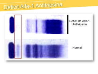 Alfa-2 Lipoproteína (VLDL)