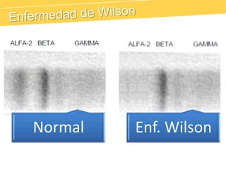 PCR*RFASdNFoCu, RFAReacción de Fase AgudaInfección, Inflamación, Fiebre, NeoplásicasInsuficiencia adrenalTratamiento con esteroidesDM avanzadaSíndrome NefróticoEIIMalnutriciónAnemia MegaloblásticaEnteropatías pierde-proteínasEnfermedades HepáticasEnfermedad de Wilson