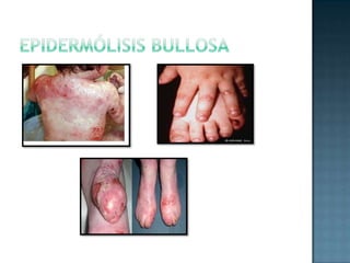 Epidermólisis bullosa