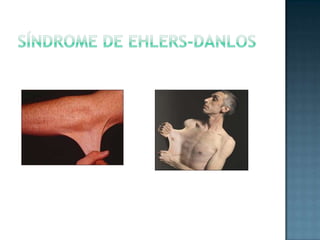 Síndrome de ehlers-danlos