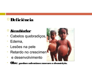  Deficiência
 Kwashiorkor
• Cabelos quebradiços,
• Edema,
• Lesões na pele
• Retardo no crescimento
• e desenvolvimento
• Obs: gordurasubcutâneamascaraadesnutrição.
 