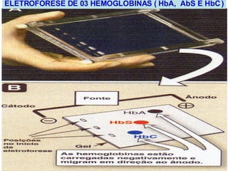 ELETROFORESE DE 03 HEMOGLOBINAS ( HbA,  AbS E HbC ) 