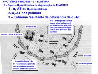 PROTEÍNAS FIBROSAS –E – ELASTINA B – Papel da  α 1 -antitripsina na degradação da ELASTINA 1  –  α 1 -AT ou  α 1 -antiproteinase 2 –  α 1 -AT nos pulmões 3 – Enfizema resultante da deficiência de  α 1 -AT A  α 1  –antitripsina normal mente inibe a elastase li berada durante a fagoci- tose, por neutrófilos pre sentes nos alvéolos dos  pulmões Uma deficiência  de α 1  – antitripsina permite que a elastase dos neu- trófilos destrua o pulmão elastina α 1 -antitripsina neutrófilo ALVÉOLOS PULMONARES 