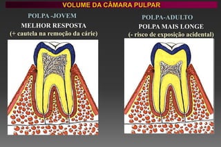 VOLUME DA CÂMARA PULPAR
POLPA -JOVEM POLPA-ADULTO
MELHOR RESPOSTA
(+ cautela na remoção da cárie)
POLPA MAIS LONGE
(- risco de exposição acidental)
 